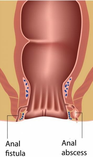 Pilonidal Cyst Treatment Atlanta - Colorectal Specialists