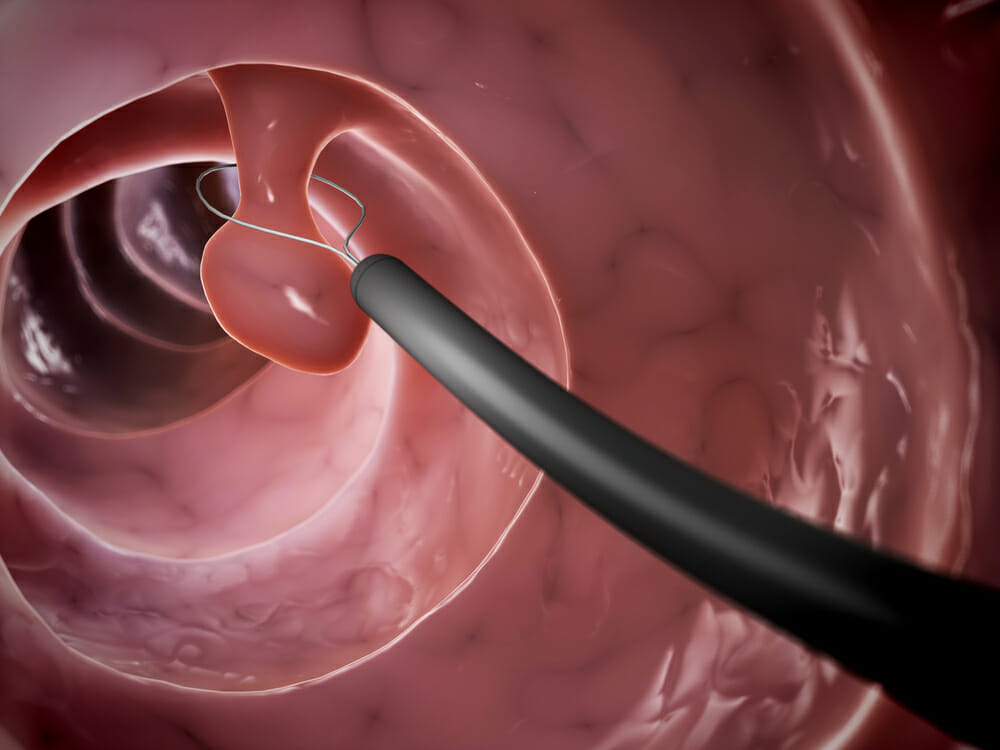 Colon Polyp Treatments Atlanta Colorectal Specialists