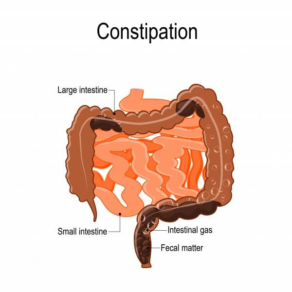 Constipation Treatment in Atlanta