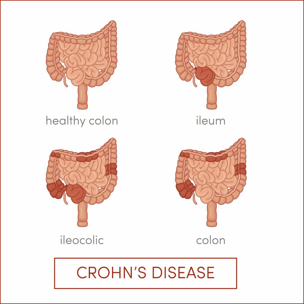 Crohn’s Disease Treatment Atlanta | IBD & IBS Stockbridge