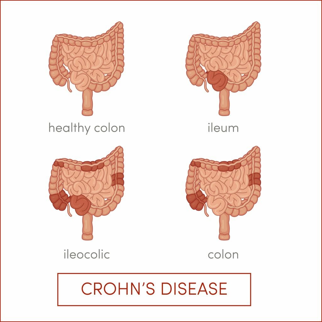 Crohn’s Disease Treatment Atlanta IBD & IBS Stockbridge