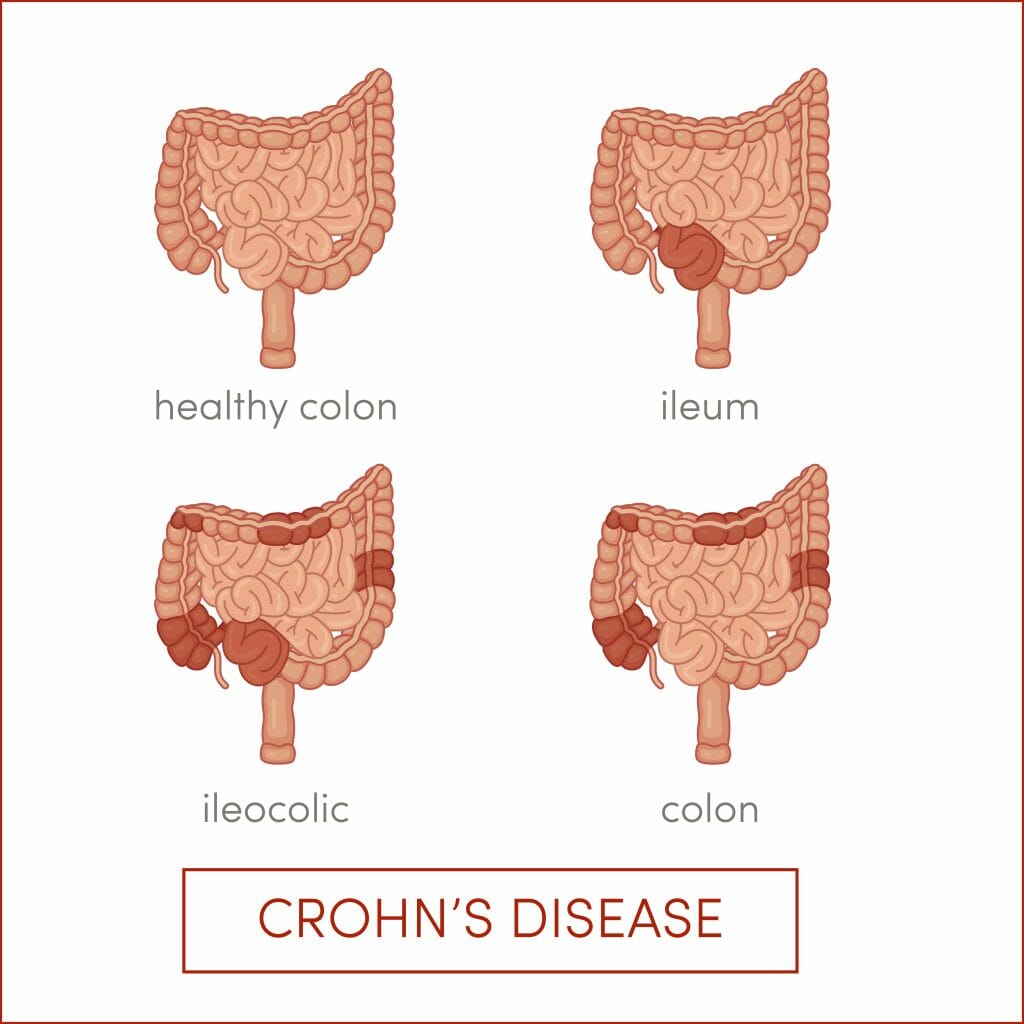 Crohn s Disease Treatment Atlanta IBD IBS Stockbridge