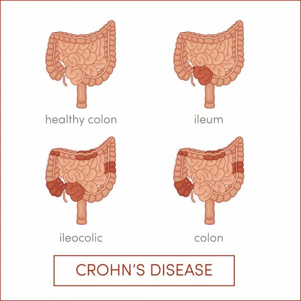 Crohn’s Disease Treatment Atlanta