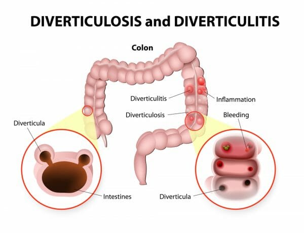 Diverticulitis Treatment Atlanta