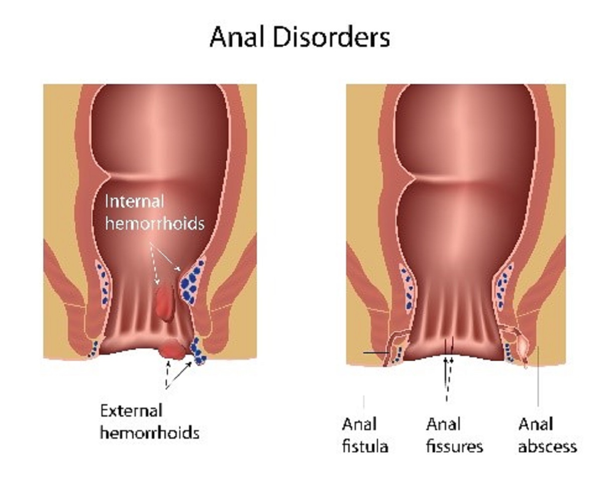 hemorrhoids and rectal prolapse treatment 