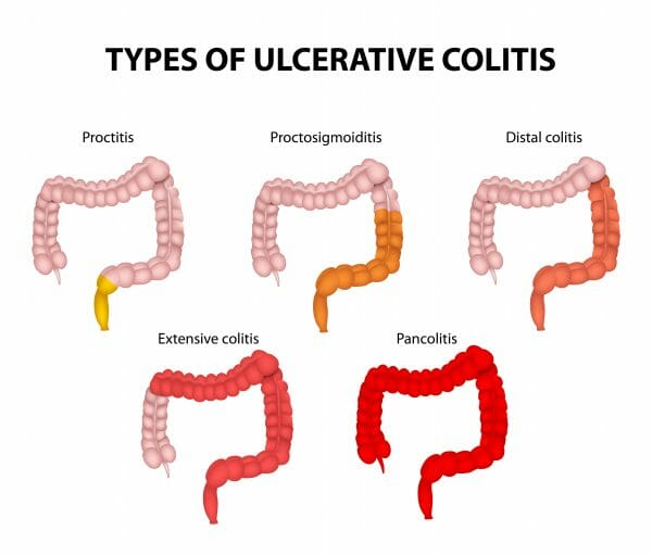 Colon Ulcerative Colitis Treatment Atlanta