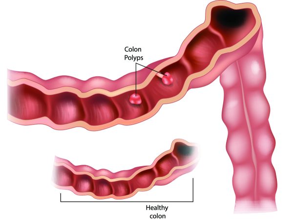 Colon polyps Atlanta, GA 