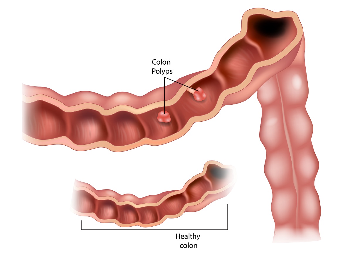 Answering Faqs About Colon Polyps Atlanta Piedmont Colorectal 