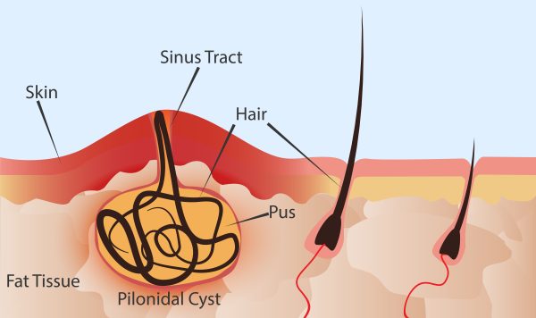 Illustrated diagram of a pilonidal cyst.