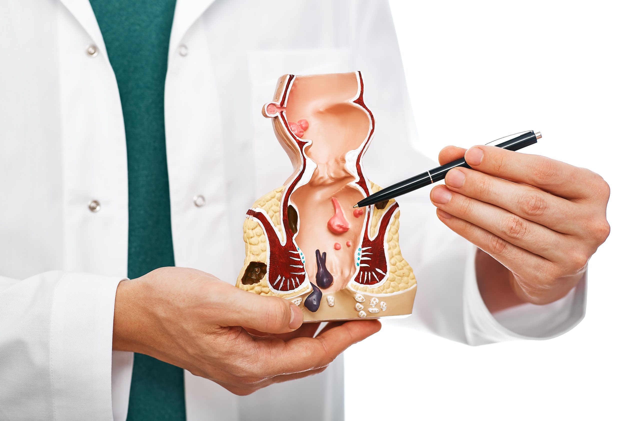Doctor holds model of the rectum prior to lower anterior resection (LAR)
