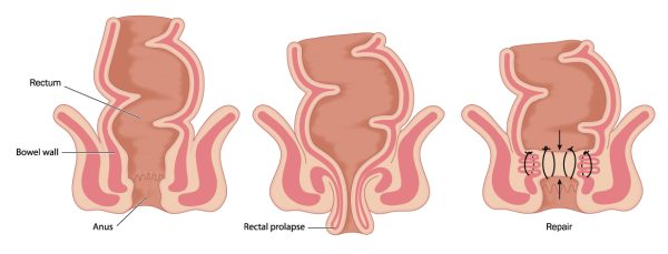 Diagram shows rectal prolapse.