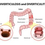 Diverticulitis treatment in Atlanta