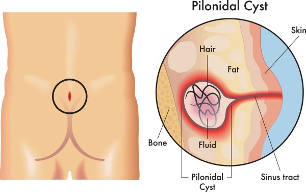 Diagram shows pilonidal cyst with components labeled.